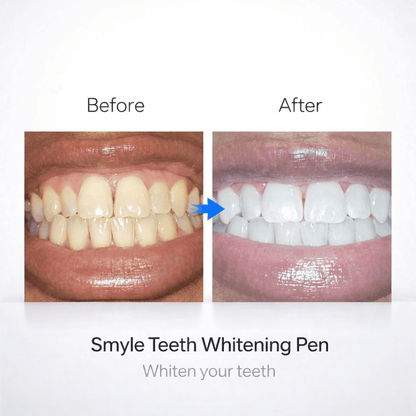 Smyle - Teeth Whitening Pen